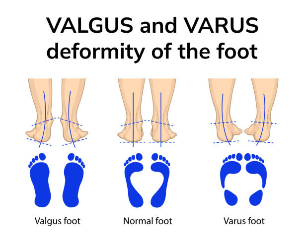 ourtward-tilting foot (foot supination)