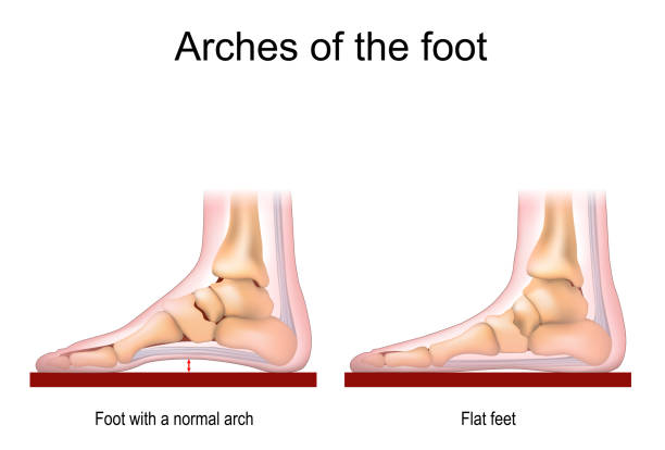 flat foot