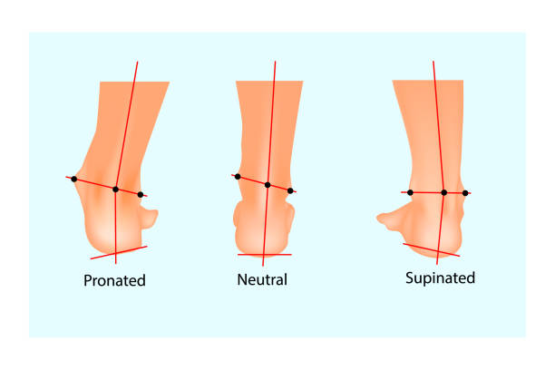 inward-tilting foot (foot pronation)